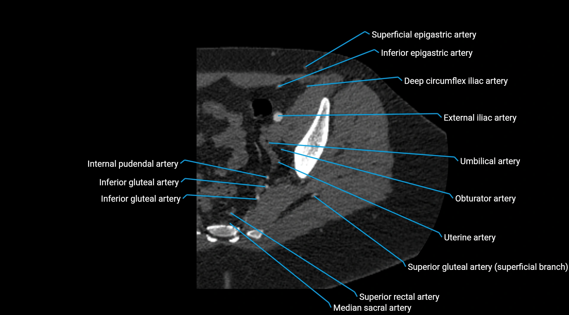 CTA lower limb cross sectional anatomy labelled image _39.webp